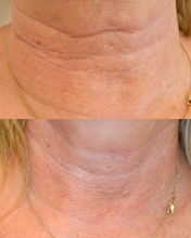 Load image into Gallery viewer, Tixel Laser - Buy 2 Get 1 Free