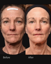 Load image into Gallery viewer, 20% OFF Sofwave Full Face
