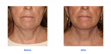 Load image into Gallery viewer, Sofwave | Full Face Treatment