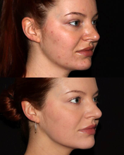 Load image into Gallery viewer, Morpheus8 - Buy 3 Get 1 FREE
