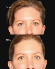 Load image into Gallery viewer, 20% OFF Sofwave Eyes
