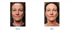 Load image into Gallery viewer, Sofwave | Full Face Treatment
